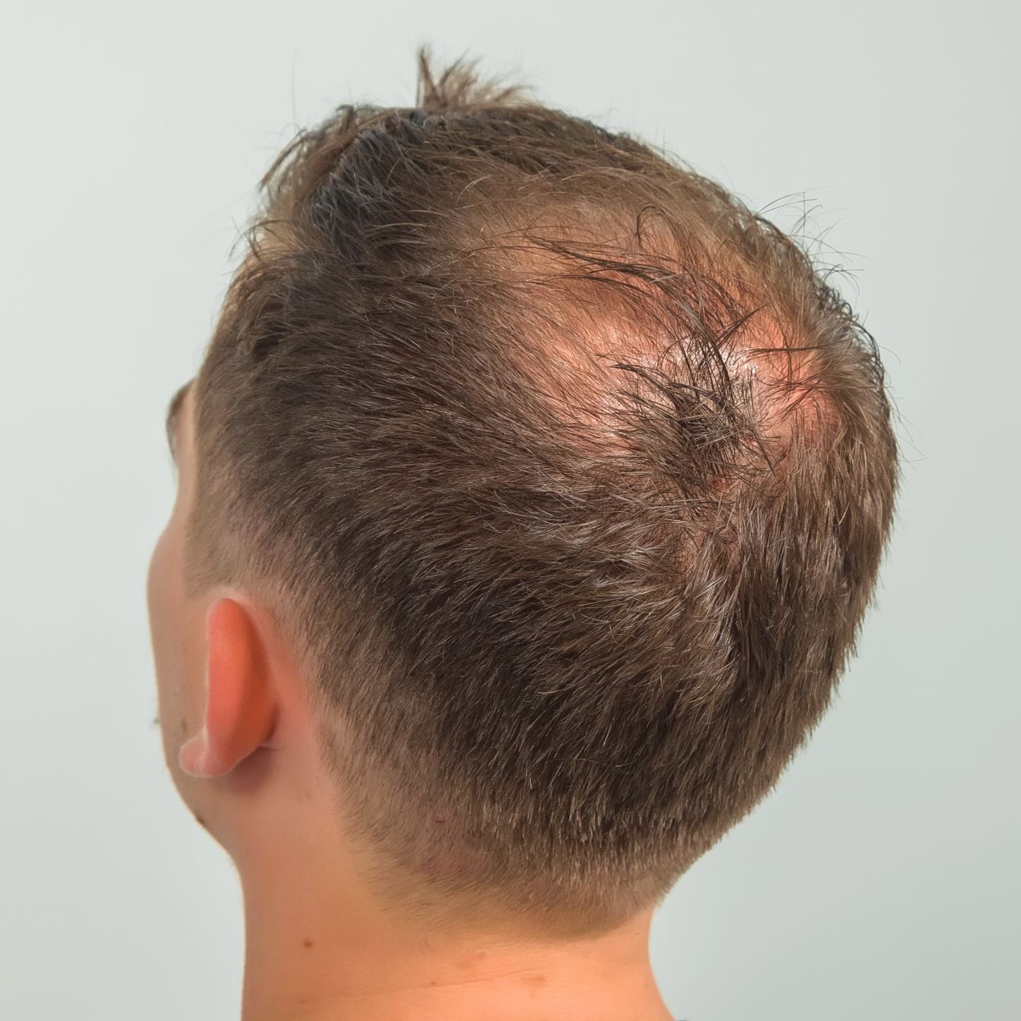 Quick Test May Help Spot Male Hair Loss - CBS News