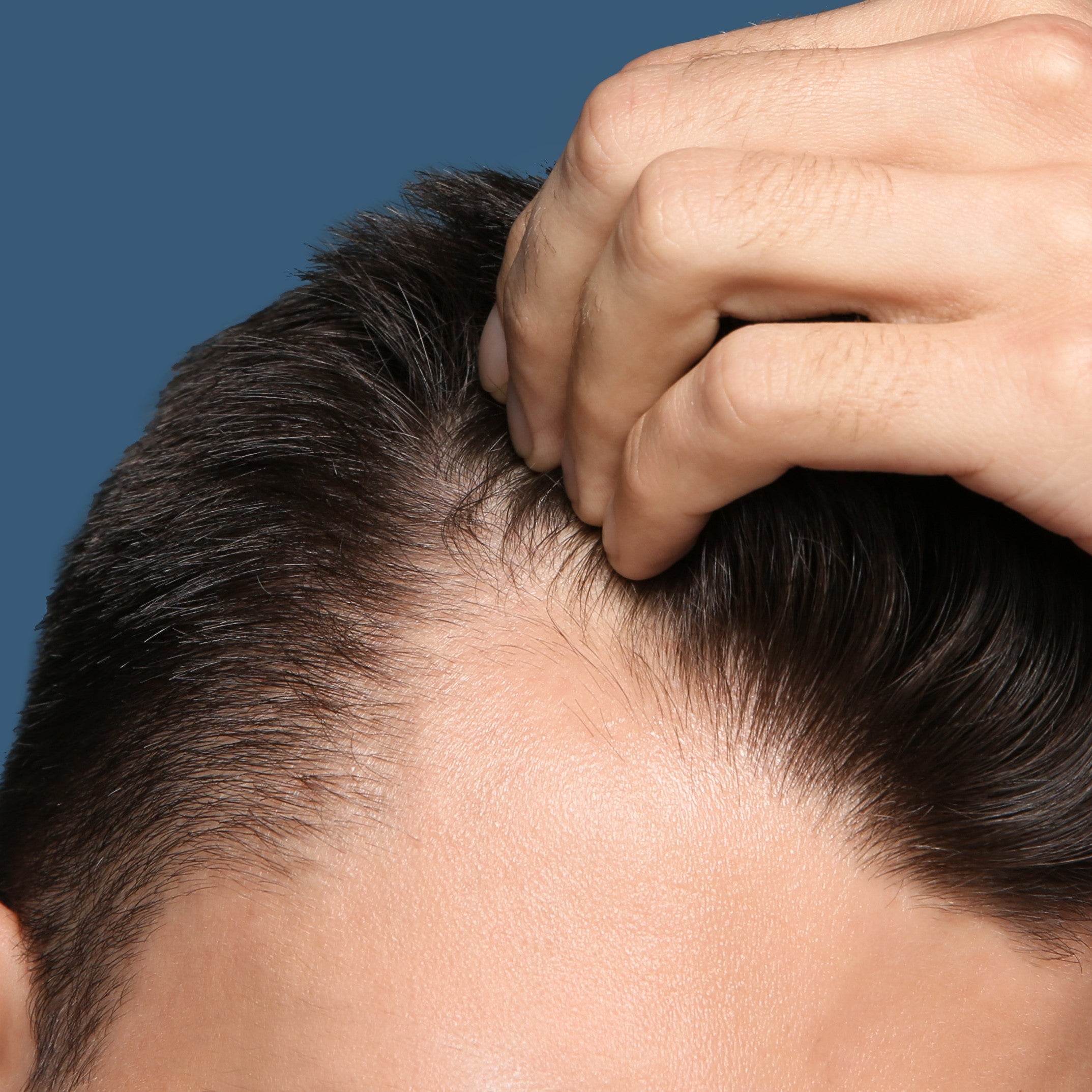 The Signs of Hair Loss in Men (It's More Than Thinning Hair)