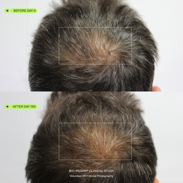 Before and after results, volunteer 29