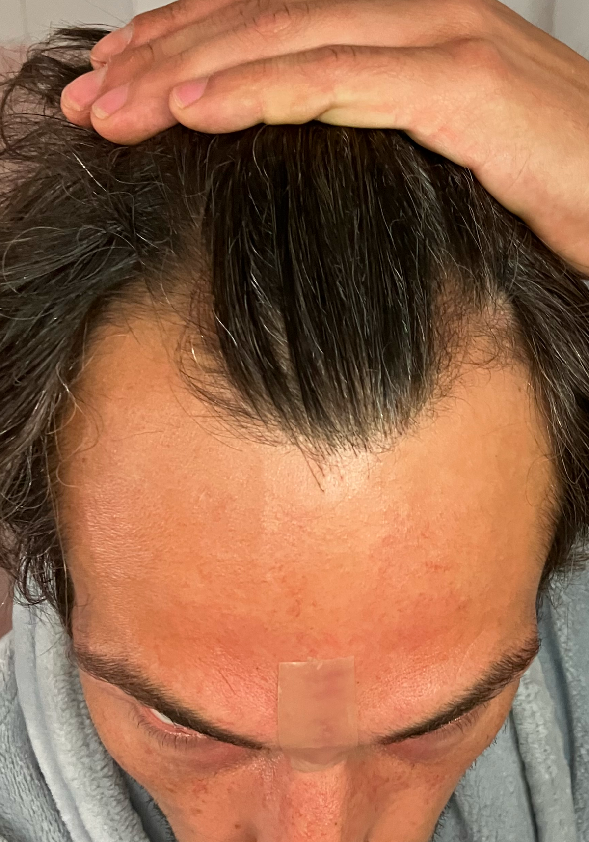 Hairline analysis overlay