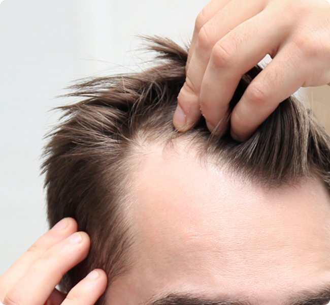 Man checking his hairline in a mirror
