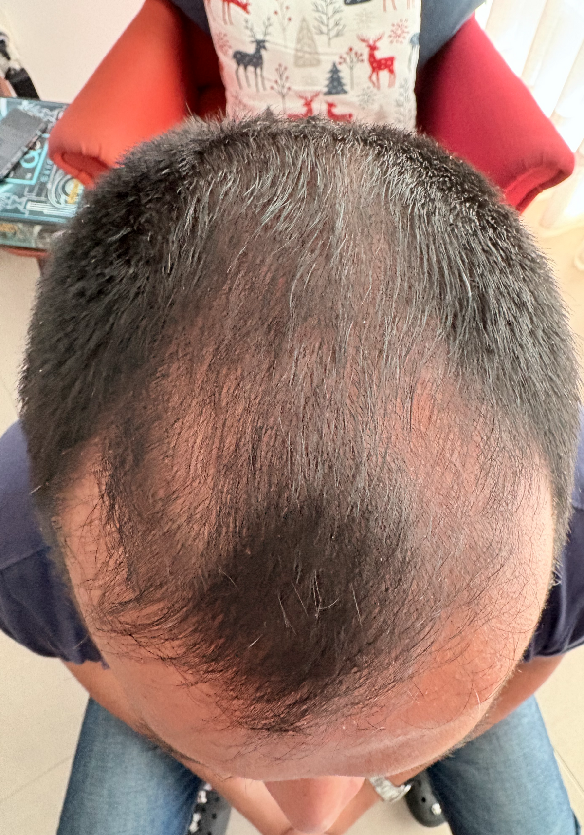 Clinical scalp view for men