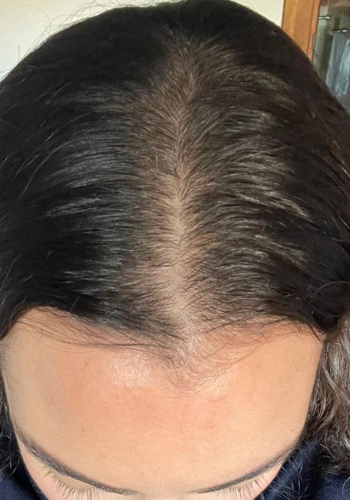 Clinical scalp view for women